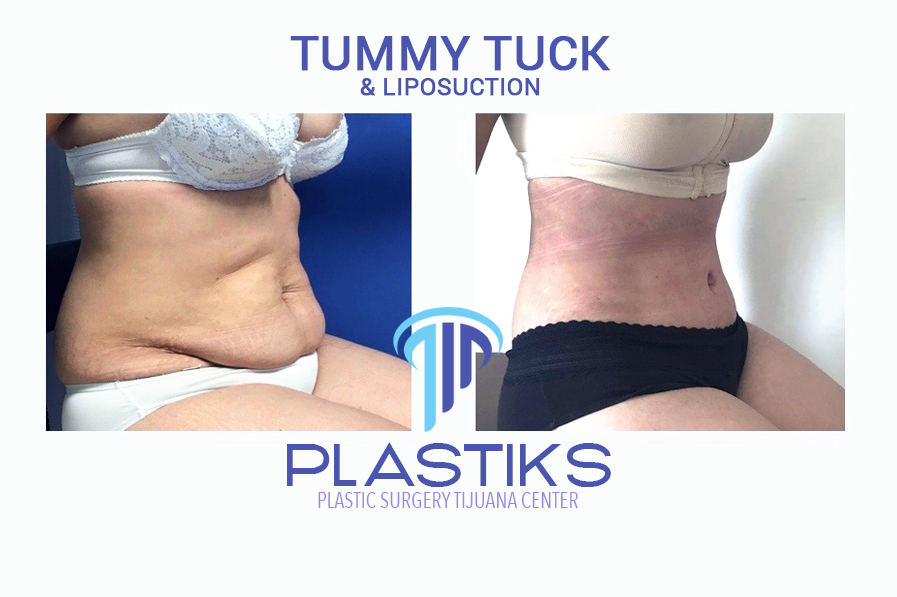 Tummy Tuck Gallery  Plastic Surgery Tijuana Center
